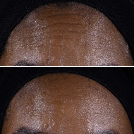 CLINIQUE-Smart Clinical Repair - Crème Liftante Visage + Cou CLINIQUE-Smart Clinical Repair - Crème Liftante Visage + Cou